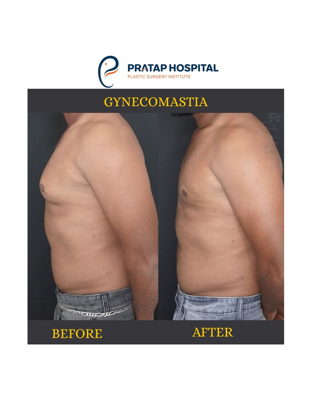 Gynecomastia After