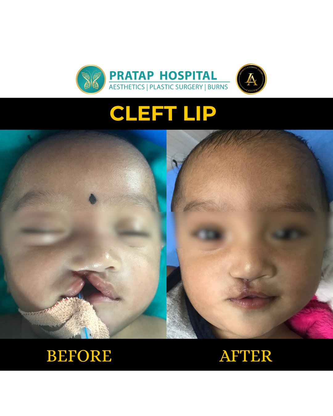 Gynecomastia After